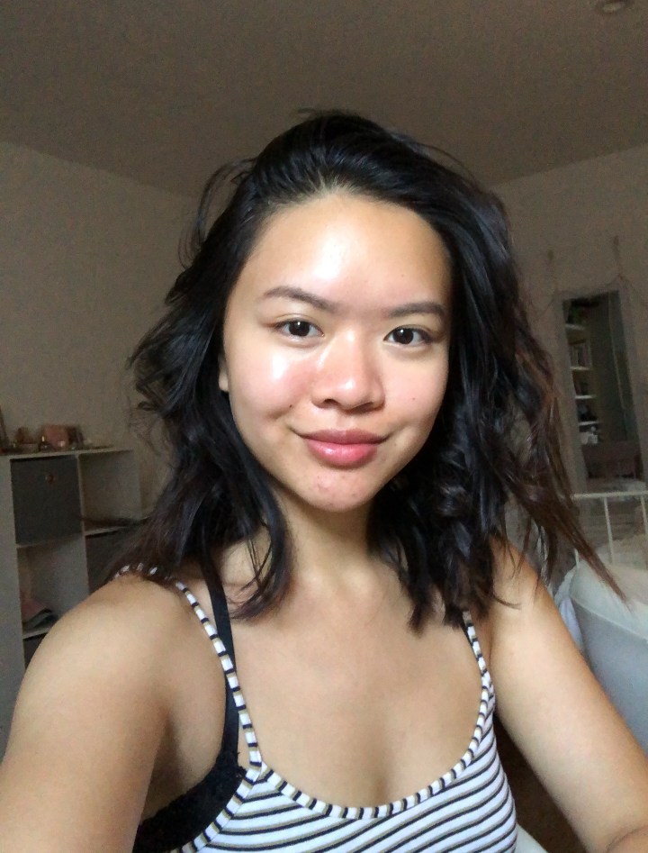 HOW I CLEARED MY CHIN&nbsp;ACNE